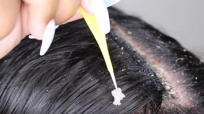 If you're thinking of scraping your dandruff for likes - please don't - BBC  Three