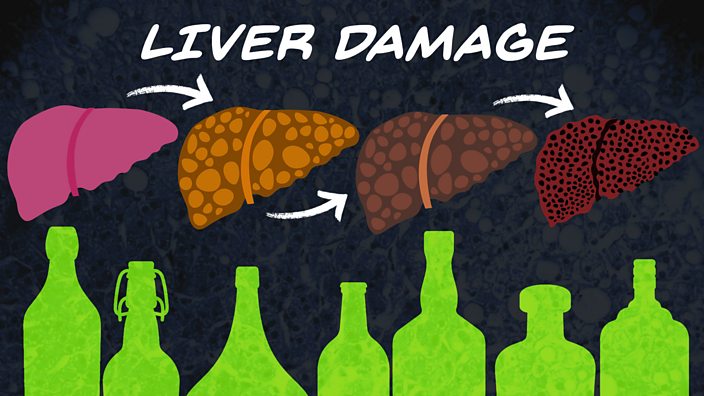 An illustration of the stages of liver disease