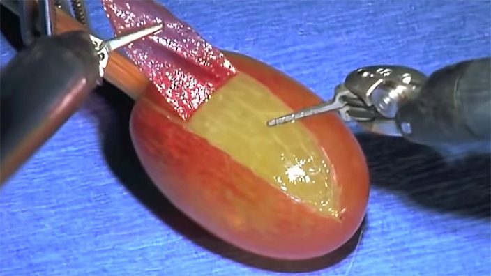 robot grape surgery