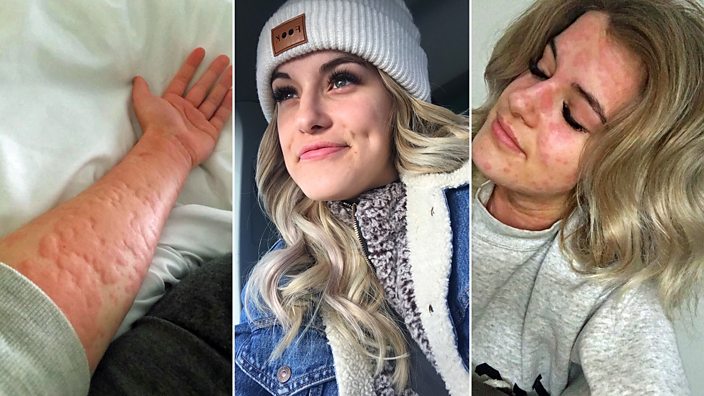 Three images of Arianna Kent, suffering an allergic reaction in two of them
