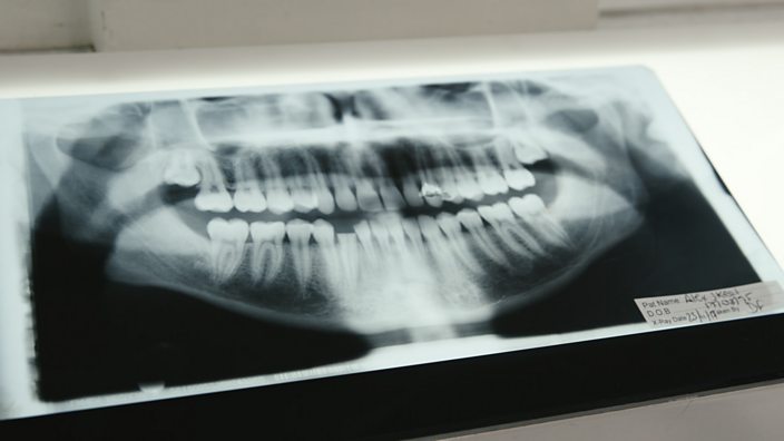 An x-ray of Alex's mouth showing his broken teeth