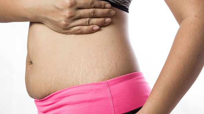 Profile of one mum's stomach with stretch marks