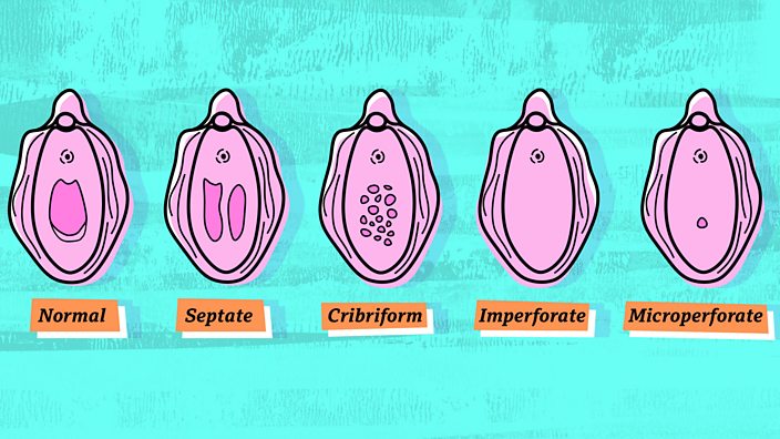 Hymen abnormalities: first tampon put me in - BBC