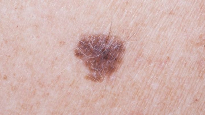 Arm Mole Count Predicts Skin Cancer Risk Bbc News 