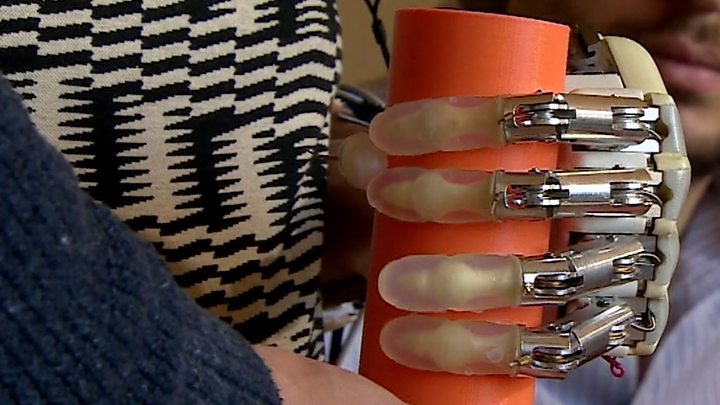 Woman Receives Bionic Hand With Sense Of Touch Bbc News