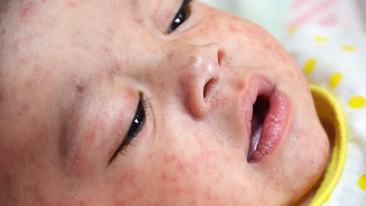 Measles: Experts call for compulsory vaccination