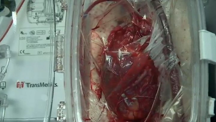 Man given transplanted heart that was kept 'alive' outside ...