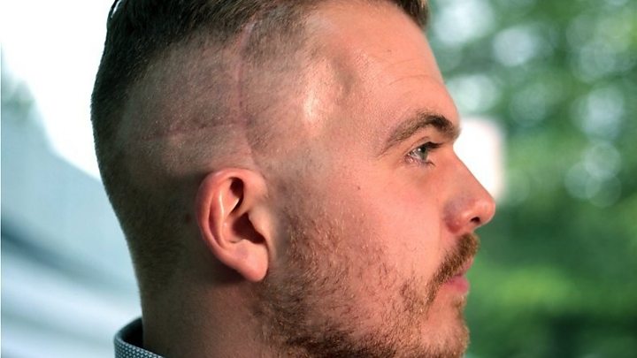 Cancer Treatment Men Should Talk About Hair Loss Bbc News