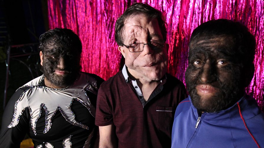 BBC Three Adam Pearson Freak Show, Two wolfboys and an
