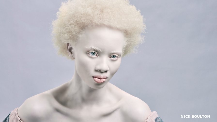 bbc-living-with-albinism