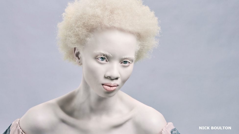 BBC - Living with albinism