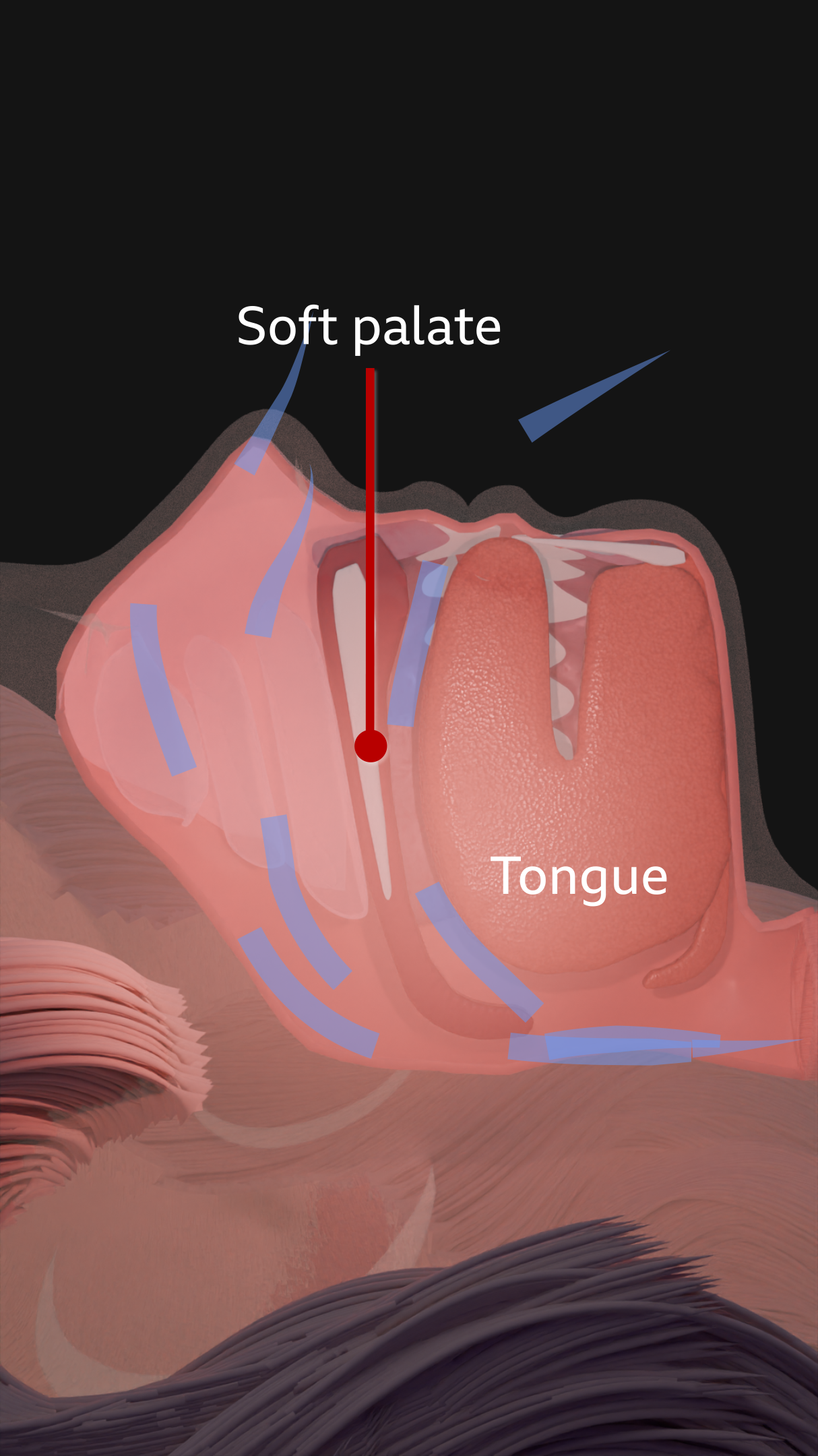 Side-view anatomical illustration of the head and throat showing the airway during breathing. The tongue, soft palate, and throat muscle are labeled, with blue arrows indicating airflow through the mouth and throat. The soft tissues appear relaxed and partially narrowing the airway, illustrating how obstruction can occur, as in sleep apnea.