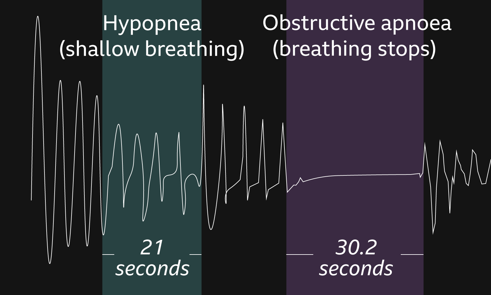 Chart showing Ruth Clegg's breathing pattern with peaks and troughs including a period of smaller peaks and troughs labelled as Hypopnea (shallow breathing) and a period where the line is flat labelled as obstructive apnoea