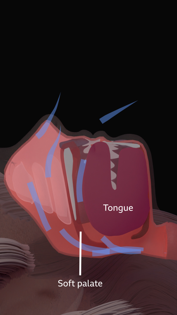 Side-view anatomical illustration of the head and throat showing the airway during breathing. The tongue, soft palate, and throat muscle are labeled, with blue arrows indicating airflow through the mouth and throat. The soft tissues appear relaxed and partially narrowing the airway, illustrating how obstruction can occur, as in sleep apnea.