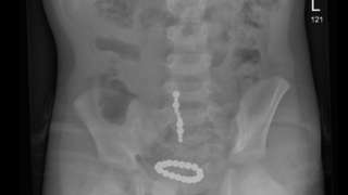 X ray showing magnets in child's intestine