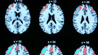 Neural images showing brain activity