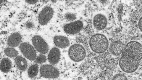 An electron microscopic image of monkeypox particles