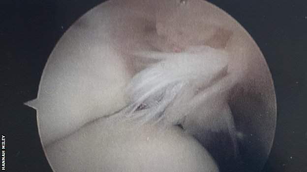 An X-ray showing Hannah Miley's frayed 'extra' ankle ligament