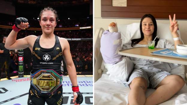 UFC champion Grasso has hand surgery