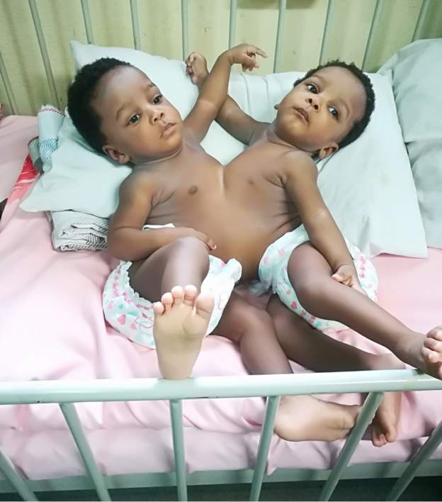 78 doctors successfully separate one-year-old Nigerian conjoined twins