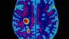 Сканирование мозга, показывающее признаки, указывающие на рассеянный склероз