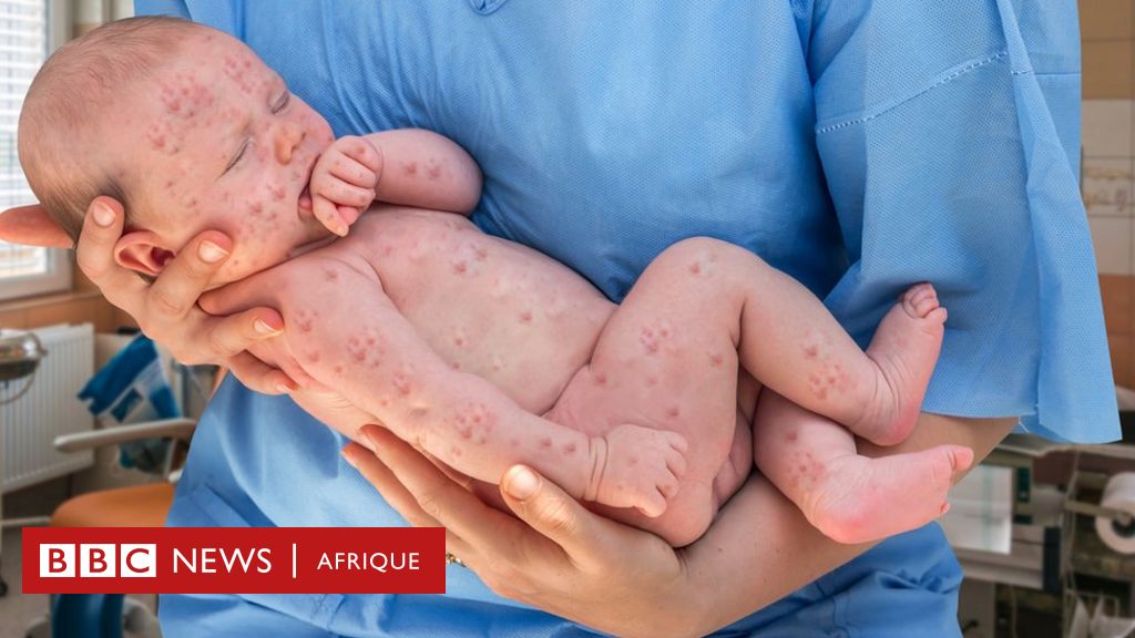 Rougeole : ces huit mythes sur la vaccination sont à l'origine d ...