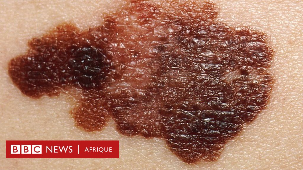 Cancer de la peau : comment identifier si des taches et d'autres ...