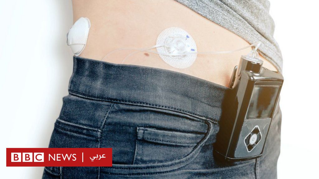 البنكرياس الصناعي: تكنولوجيا جديدة لمساعدة مرضى داء السكري - BBC News عربي