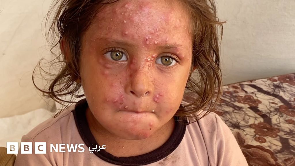الحساسية تتفشى في غزة وسط تكدس المخيمات ونقص الدواء والماء