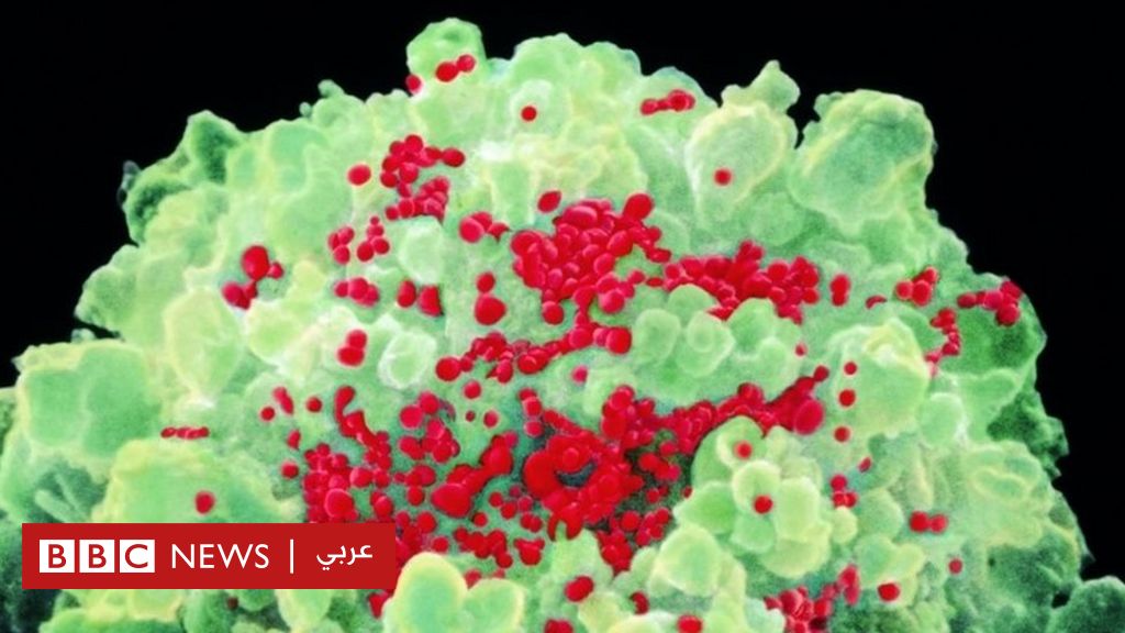 الأيدز: تعافي "أول امرأة" في العالم من فيروس نقص المناعة البشرية بعد علاجها بخلايا جذعية