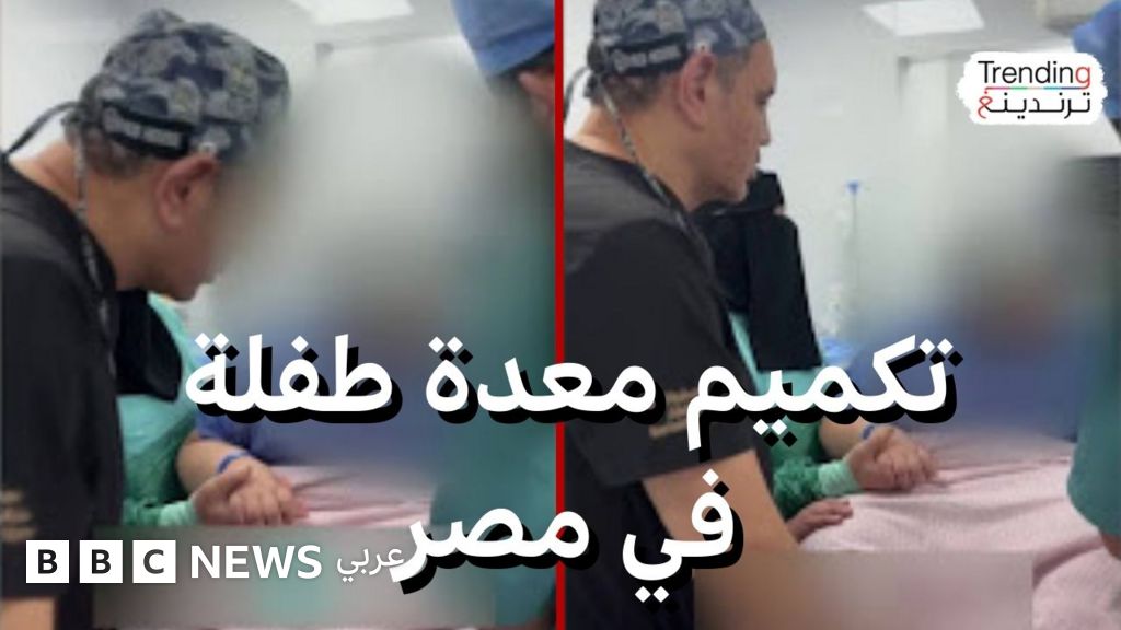 عملية تكميم معدة طفلة في مصر تثير جدلا.. هل هذه الجراحات ملائمة للأطفال؟