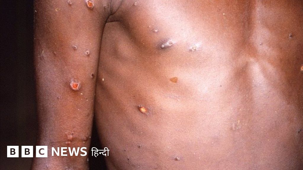 मंकीपॉक्स वायरस से क्या आपको परेशान होने की ज़रूरत है