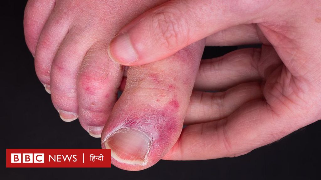 कोविड टो: कोरोना के कारण पैर के अंगूठे और उंगलियों पर क्यों हो रहा है असर