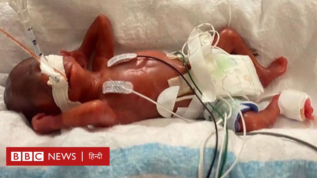दुनिया का सबसे प्रीमैच्योर जन्मा बच्चा, जिसका वज़न आधा किलो भी नहीं