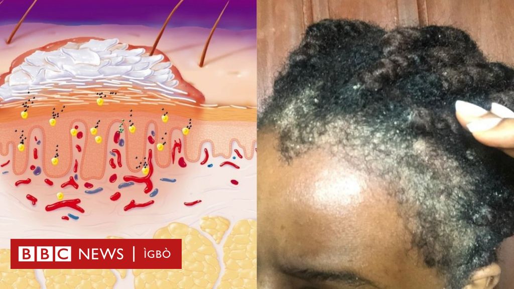 peeling scalp psoriasis)