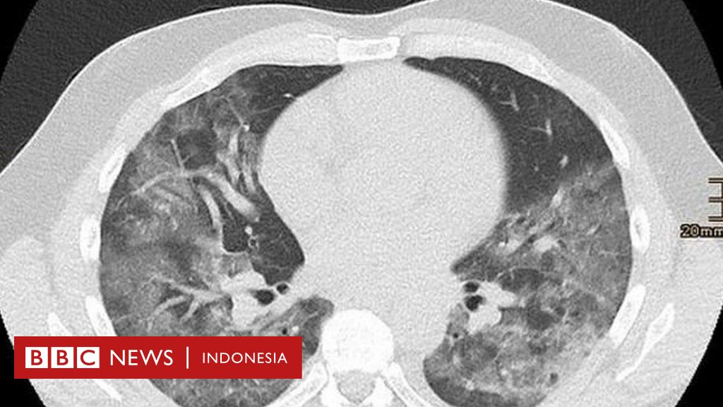 Covid 19 Tanpa Simtom Kerusakan Pada Paru Paru Terhadap Pasien Virus Corona Tanpa Gejala Yang Diketahui Sejauh Ini Bbc News Indonesia