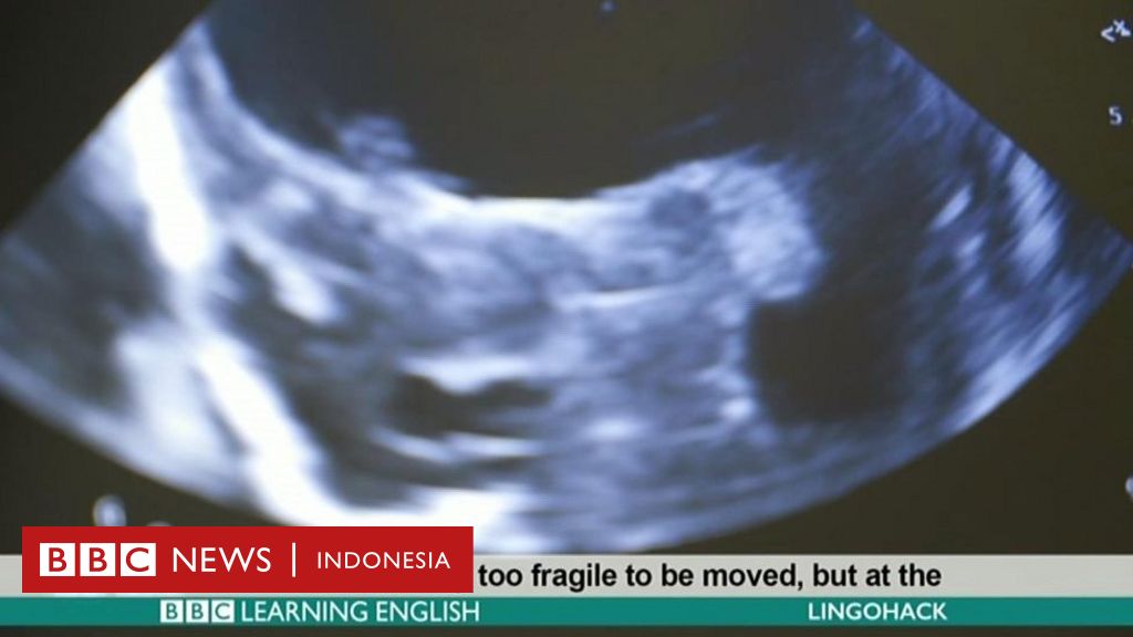 Help for UK babies BBC News Indonesia