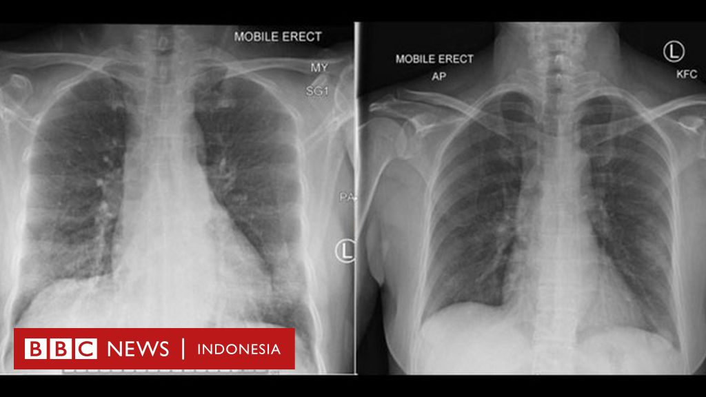 Virus Corona Ilmuwan Australia Ungkap Cara Sistem Kekebalan Tubuh