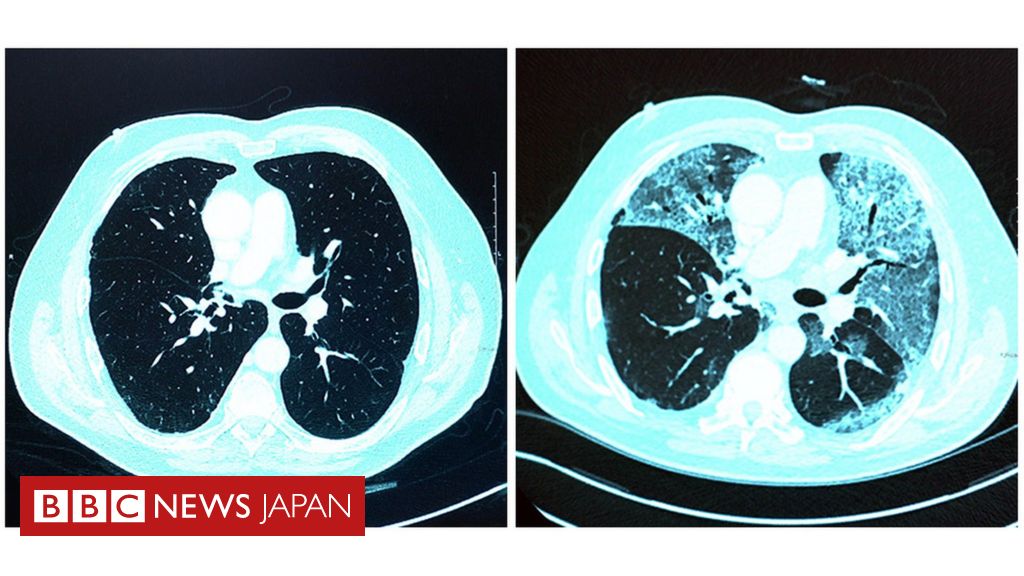 新型ウイルス重症者 肺に損傷残る恐れ 英医師ら警告 cニュース