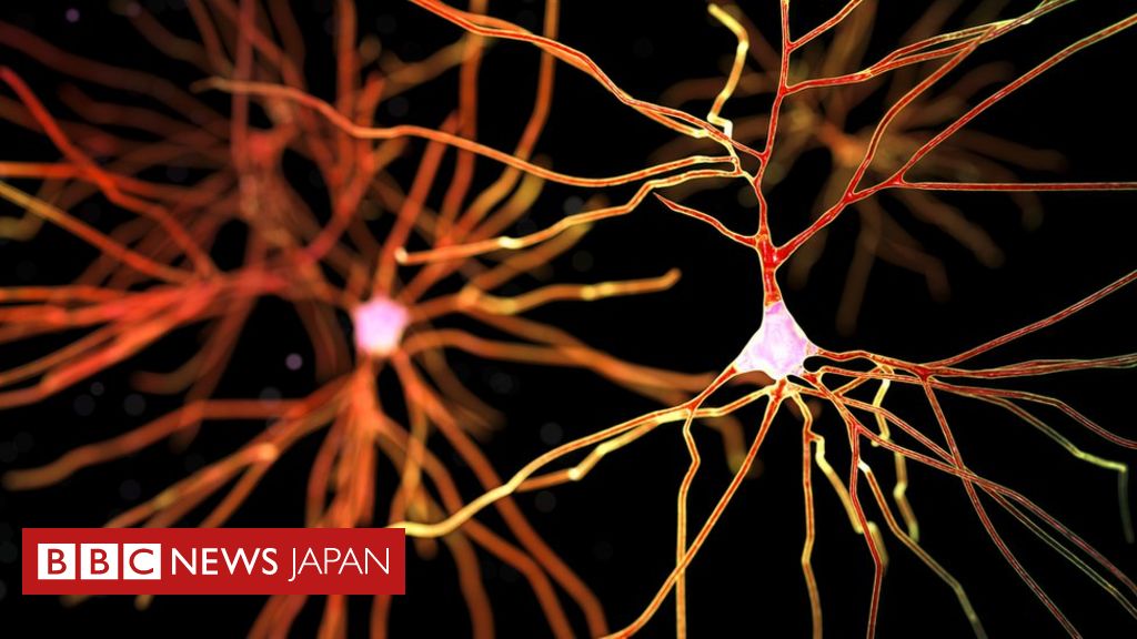 アルツハイマー患者 実は別の種類の認知症か 国際研究 Bbcニュース