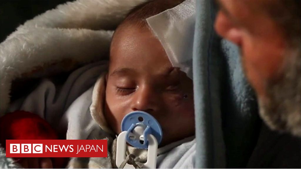 シリアの赤ちゃん砲撃で片目失い 人道危機の象徴に cニュース