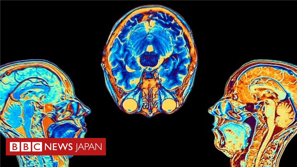 新型コロナウイルス、脳への影響が明らかに＝英研究 - BBCニュース
