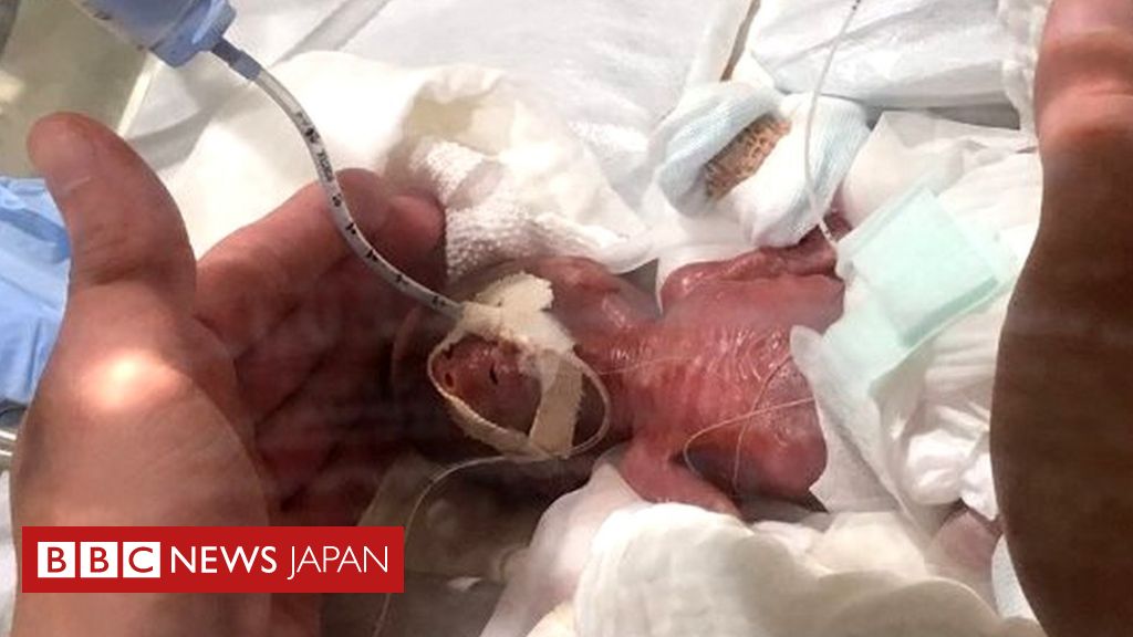 日本の 世界最小の赤ちゃん が退院 すくすくと成長し体重は約12倍に