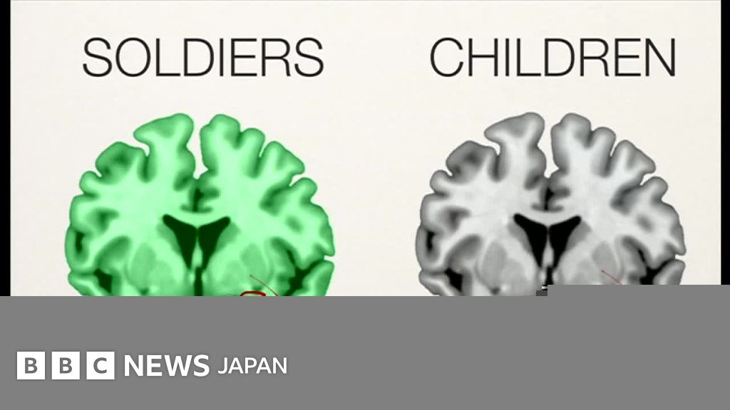 虐待受けた子どもとPTSD兵士の脳が類似=研究 BBCニュース 虐待受けた子どもとPTSD兵士の脳が類似=研究 BBCニュース
