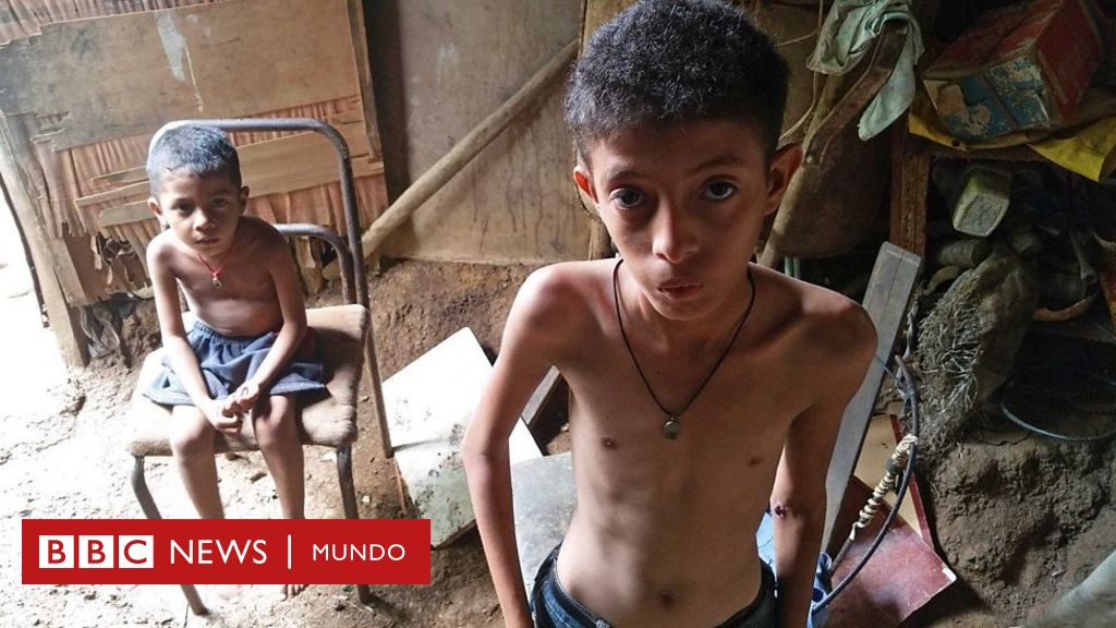 Exclusivo Bbc Mundo Las Impactantes Imágenes Que Muestran El Drama De La Severa Desnutrición 7923