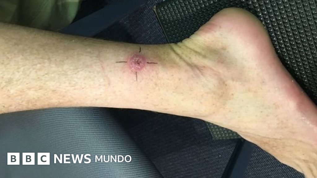 Cómo curar la infección severa de la piel