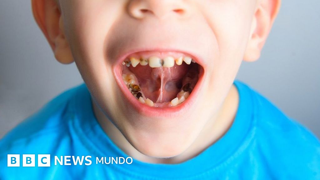 cuanto dura el dolor despues de sacarse una muela cuanto dura el dolor despues de sacarse una muela