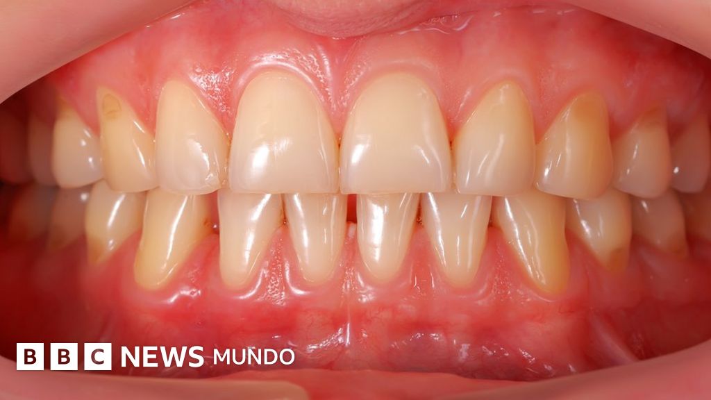 estudio de diabetes y enfermedad periodontal