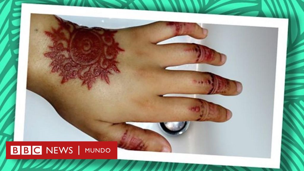 El tatuaje de henna negra de mis vacaciones que me dejó cicatrizada para siempre - BBC News Mundo
