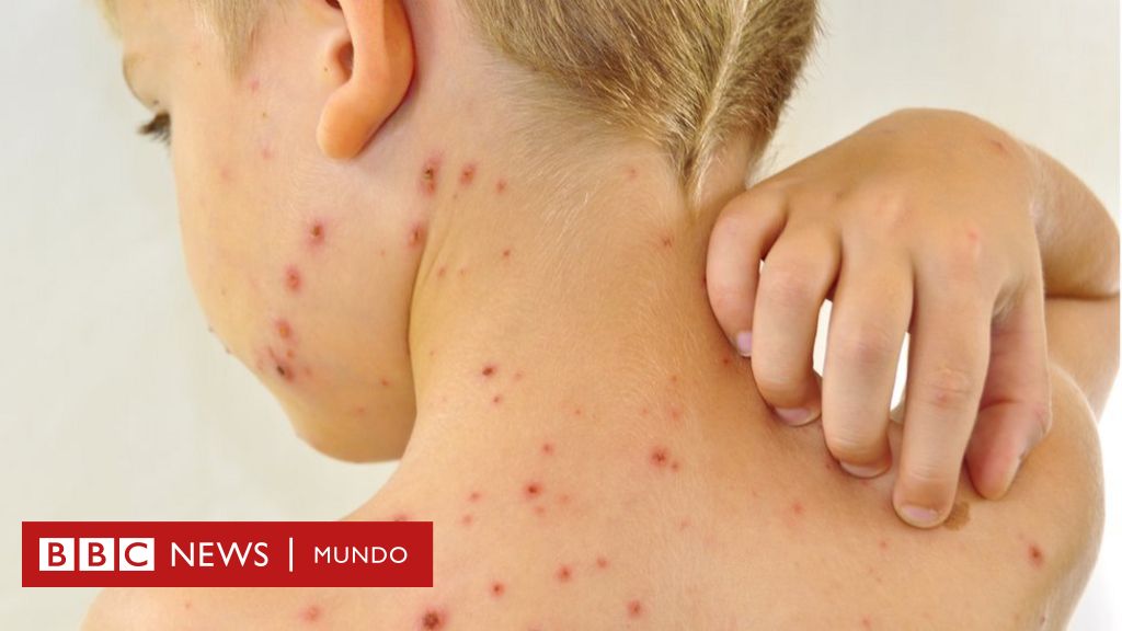 Herpes Zoster La Otra Enfermedad Que El Virus De La Varicela Te Puede Causar Cuando Se Queda Latente En Tu Cuerpo c News Mundo